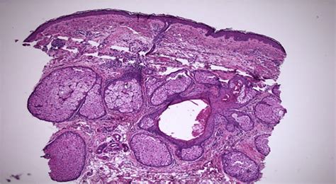 Histology Demonstrating Sebaceous Gland Hyperplasia And Absence Of