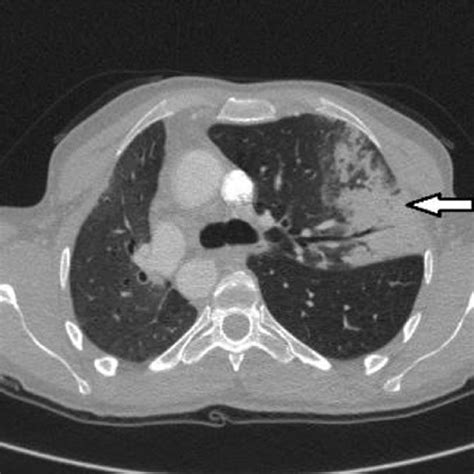 Thoracic Ct Scan Showing Air Space Consolidation Affecting The Right
