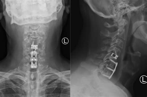 Anterior Cervical Laminectomy