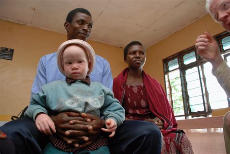 Albinos Are Still Regularly Hunted And Killed For Their Body Parts The World From Prx