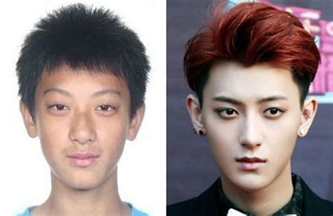 Korean Plastic Surgery Before And After