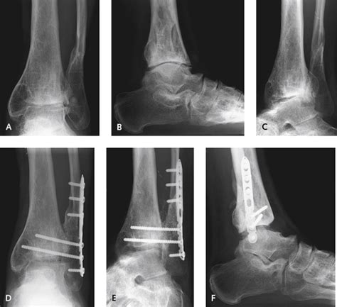 Reconstruction Of Malunited Ankle Fractures Plastic Surgery Key