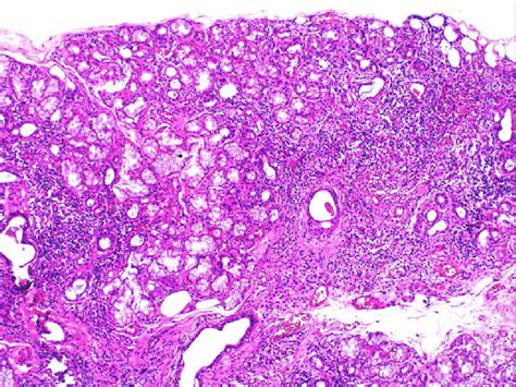 Photomicrograph Of The Histology Of The Biopsy Of The Minor Salivary Download Scientific