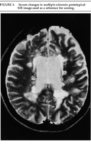 Neuropsychiatric Manifestations Of Multiple Sclerosis The Journal Of