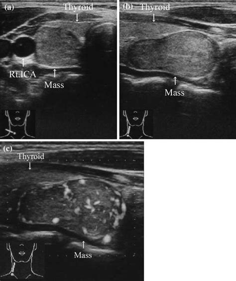 An Accessory Thyroid Gland That Presented Tumor Like Images Springerlink