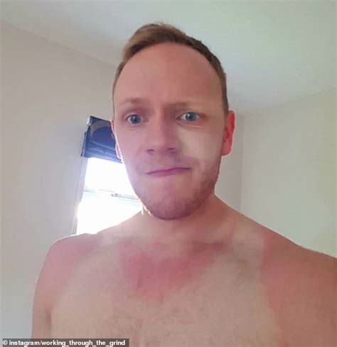 Baked Brits Share Snaps Of Their Disastrous Sunburn Following The