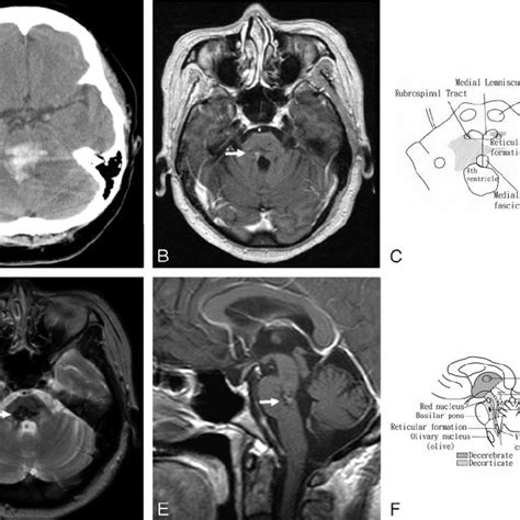 A Noncontrast Ct Of A 48 Year Old Woman Who Presented With Dr And Download Scientific Diagram