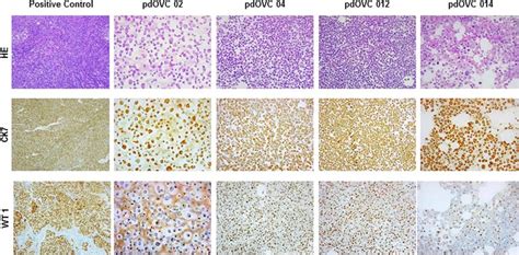 Patient Derived Ovarian Cancer Cell Lines Retain The Expression Of