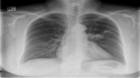 Carcinoid Syndrome Chest X Ray Wikidoc