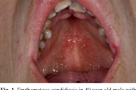 Figure 1 From Oral Manifestations Of Hiv Disease A Review Semantic