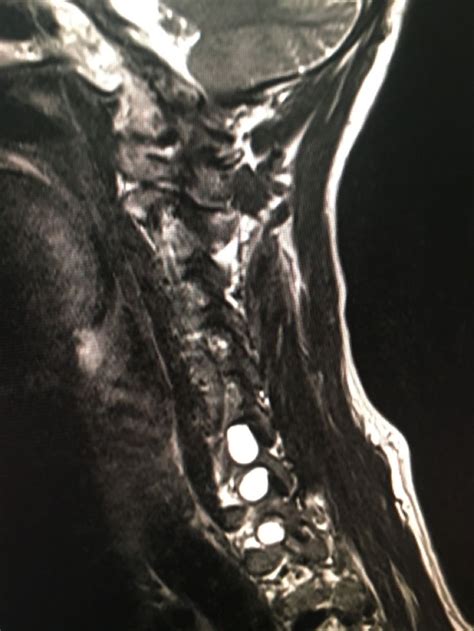 Perineural Cysts Radiology Imaging Radiology Mri