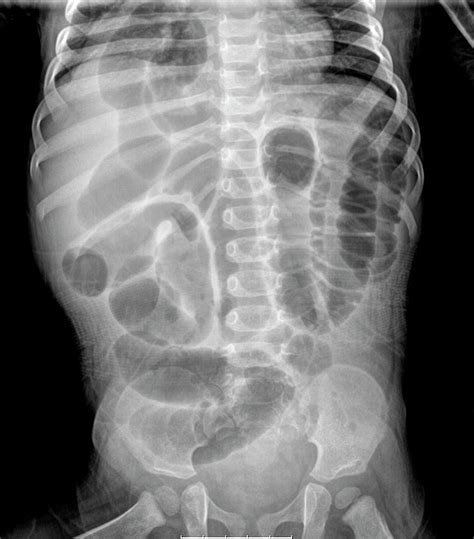 Diaphragmatic Hernia Photograph By Photostock Israelscience Photo Library