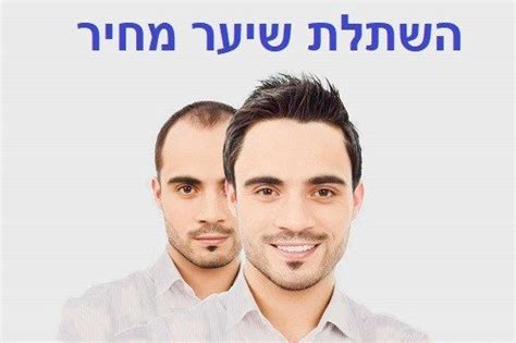 כמה יעלו הכרטיסים ואיפה ניתן לקנות? בלוג השתלת שיער בטורקיה- המדריך המקיף ביותר לפני טיסה