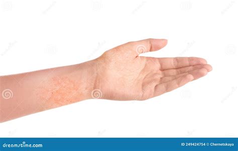 Woman Showing Hand With Dry Skin On White Background Closeup Stock