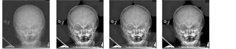 Medical Image Enhancement Using Morphological Transformation