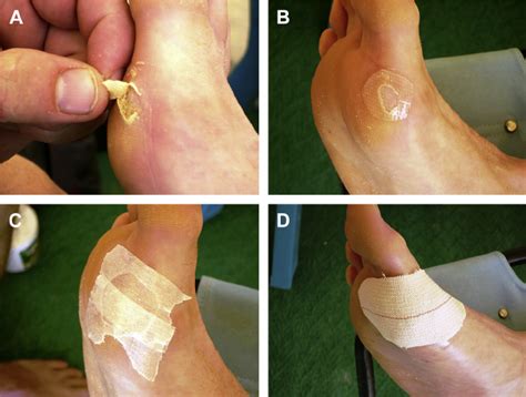 The best blister bandages for prevention and treatment protect feet and cover up hot spots. ( A ) Open blister at the metatarsal region. ( B ...
