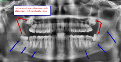 Wisdom Teeth Nerve Damage North Texas Dental Surgery