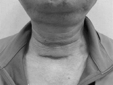 Post Thyroidectomy Adhesion A Noticeable Scar And Marked Sunken
