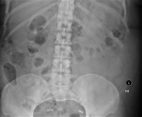 Normal Abdominal X Ray Large Bowel Gas Image Radiopaedia Org My Xxx