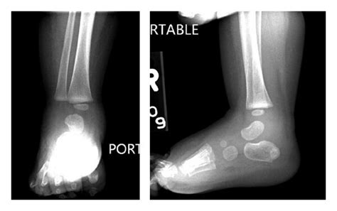 Radiograph Of Right Ankle Revealing Moderate Soft Tissue Swelling