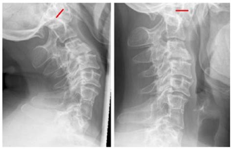 Dynamic X Rays Images Showing The Cervical Spine In Active Extension