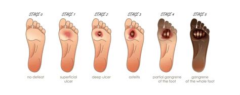 What Is The Wagner Scale Of Diabetic Foot Ulcer Stages