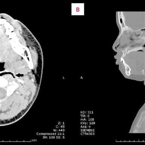 A B Ct Scan Of The Neck Sagittal And Axial View Shows Prevertebral