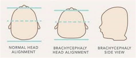 Assessment And Evaluation For Babys Flat Head Plagiocephaly