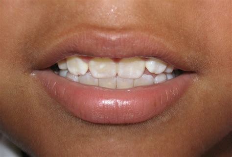 ¿qué Es La Fluorosis Dental Clinicadentalnoemicrespo