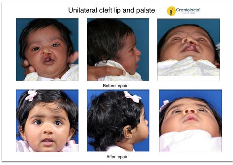 Cleft Lip And Palate Gallery Dell Childrens Craniofacial Team Of Texas