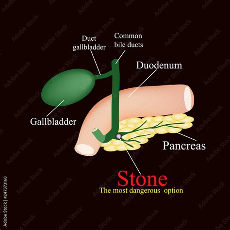 Stone Pancreatic Bile Duct The Gall Bladder Duodenum Bile Ducts