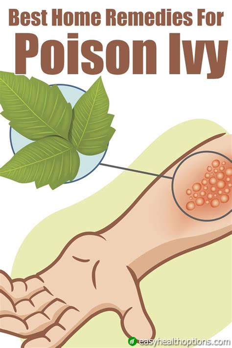 Best Home Remedies For Poison Ivy Poison Ivy Remedies Poison Ivy Home Remedies Poison Ivy