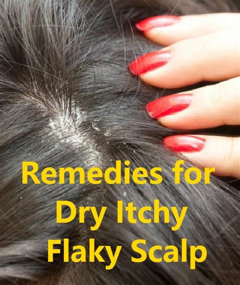 Home Remedies For Dry Itchy Flaky Scalp Dry Itchy Flaky Scalp Dry