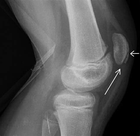 Bilateral Sleeve Fractures Of The Patella In A 12 Year Old Boy With