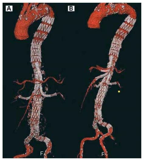 Branched Stent Graft Used For The Complete Endovascular Treatment Of A