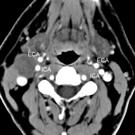 Second Brachial Cleft Cyst Mimic Case Report American Journal Of