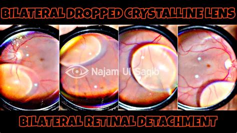 Bilateral Dropped Crystalline Lens With Bilateral Retinal Detachment