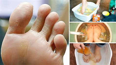 How To Get Rid Of Smelly Feet For Good Youtube