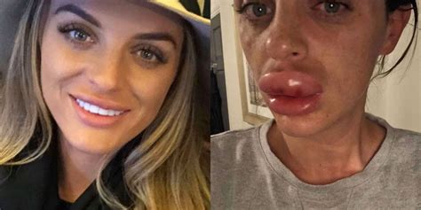 Lip Fillers Nightmare Womans Lips Suffers Artery Occlusion Dr