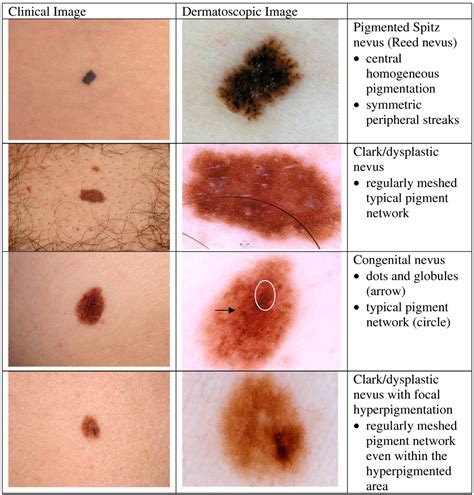 Figure 3 From Dermatoscopy An Overview Of Subsurface Morphology