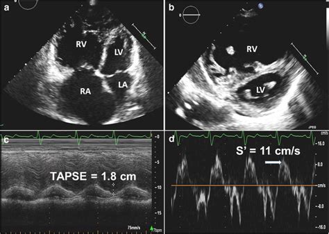 Echocardiographic Findings Of Rv Failure A Right Atrial And Right