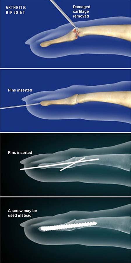 Finger Joint Fusion Dip Joint Central Coast Orthopedic Medical Group