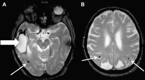 Cerebral Amyloid Angiopathy Mri Findings A Axial Slice T2 Gradient