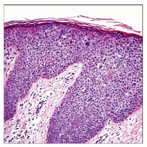 Bowenoid Papulosis Basicmedical Key