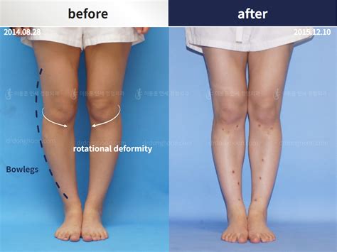 Deformity Correction Surgery Leg Deformity Bowlegs
