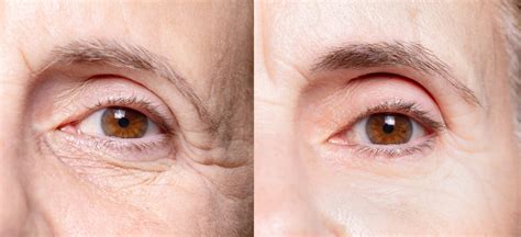 Laser For Fine Lines Under Eyes Cosmetic Surgery Tips