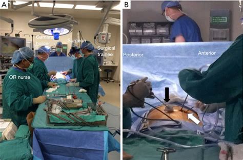 Modified Uniportal Video Assisted Thoracoscopic Surgery Vats Kara Annals Of Cardiothoracic