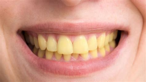 Yellow Teeth Adelaide Dental