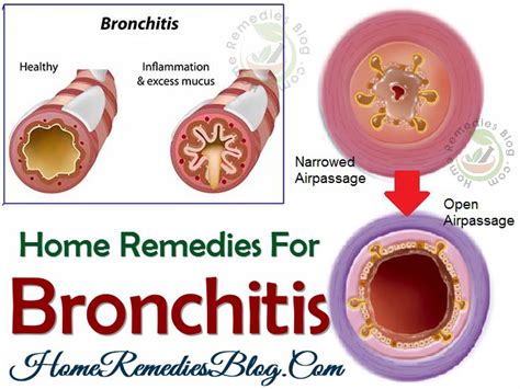 14 Proven Home Remedies To Cure Bronchitis Naturally Home Remedies Blog