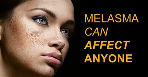 Prevention Is Best Medicine Heres A Natural Treatment For Melasma